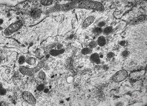 F, 49y. | myelosarcoma … histiocyte-like cells in dermal infiltrates F, 49y. | myelosarcoma … histiocyte-like cells in dermal infiltrates